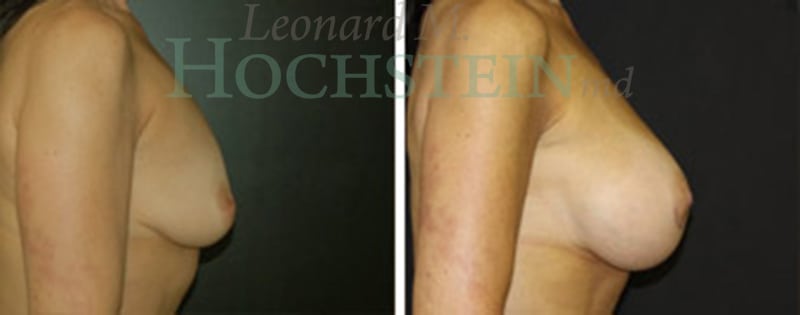 Breast Augmentation Patient