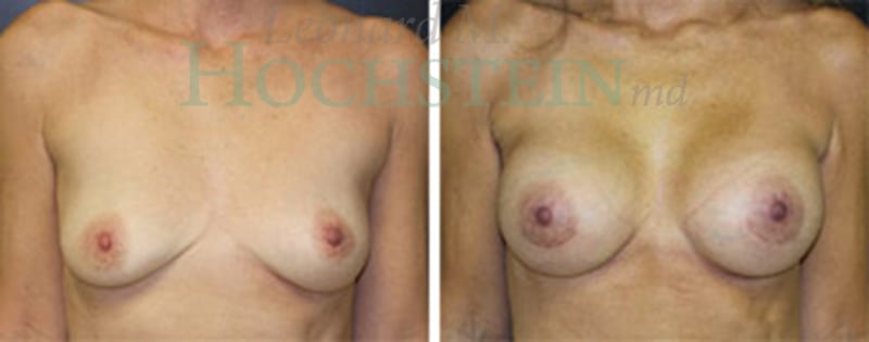 Breast Augmentation Patient