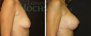 Breast Augmentation Patient