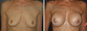 Breast Augmentation Patient