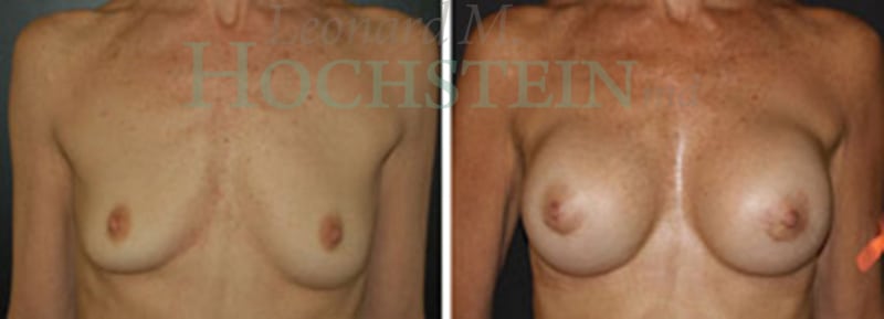 Breast Augmentation Patient