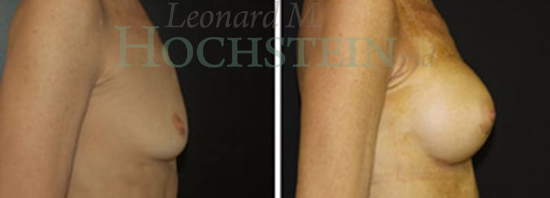 Breast Augmentation Patient