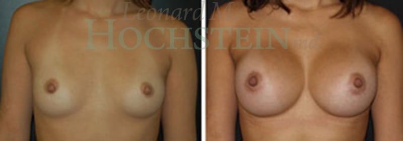 Breast Augmentation Patient