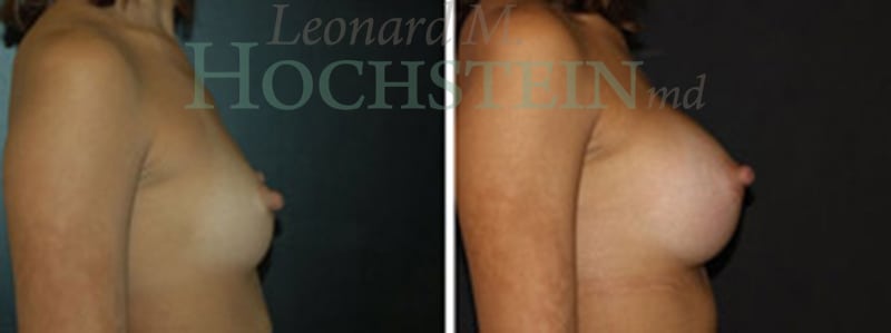 Breast Augmentation Patient