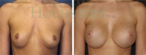 Breast Augmentation Patient