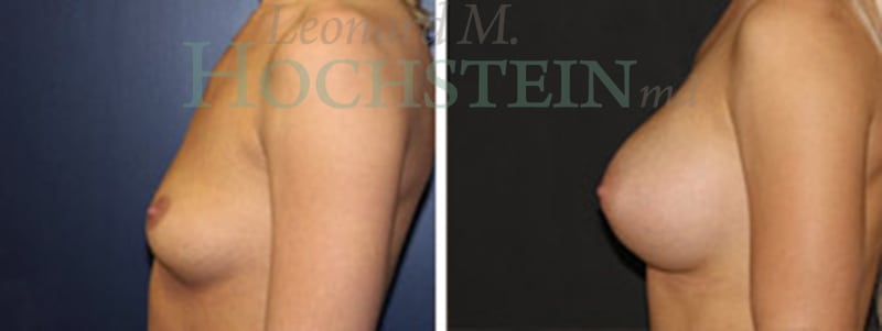 Breast Augmentation Patient