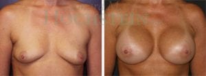 Breast Augmentation Patient