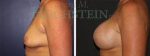 Breast Augmentation Patient
