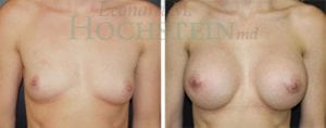 Breast Augmentation Patient