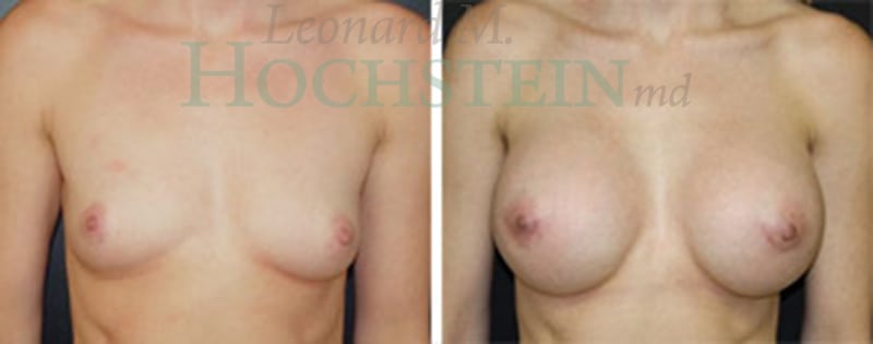 Breast Augmentation Patient