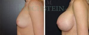 Breast Augmentation Patient