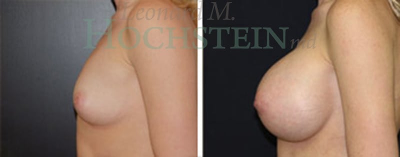 Breast Augmentation Patient