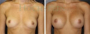 Breast Augmentation Patient