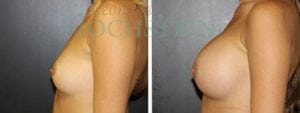Breast Augmentation Patient