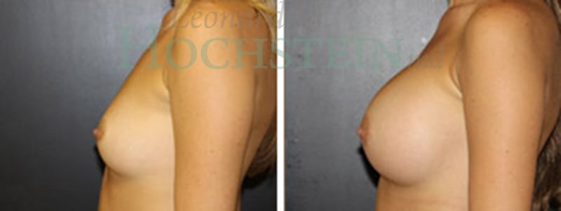 Breast Augmentation Patient