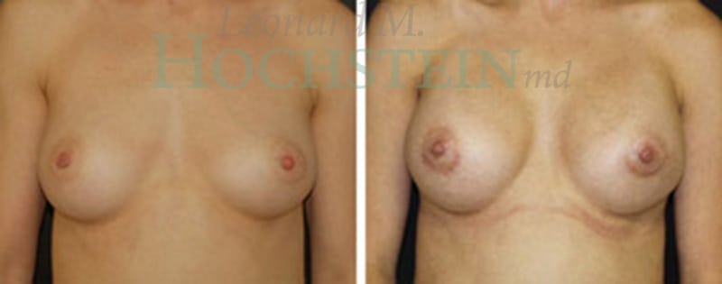 Breast Augmentation Patient