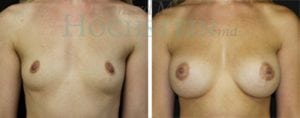 Breast Augmentation Patient