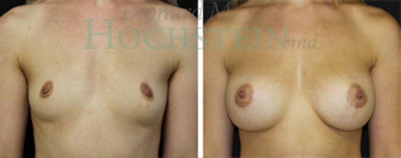 Breast Augmentation Patient