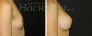 Breast Augmentation Patient