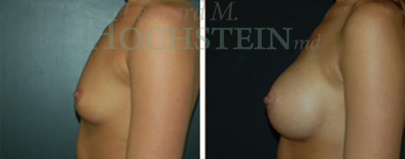 Breast Augmentation Patient