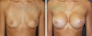 Breast Augmentation Patient