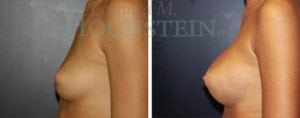 Breast Augmentation Patient