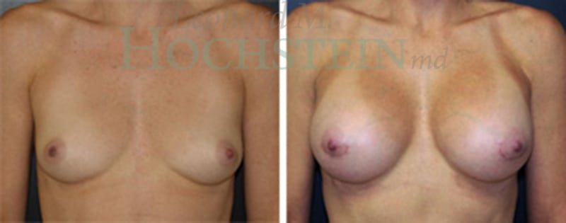 Breast Augmentation Patient