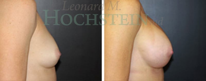 Breast Augmentation Patient