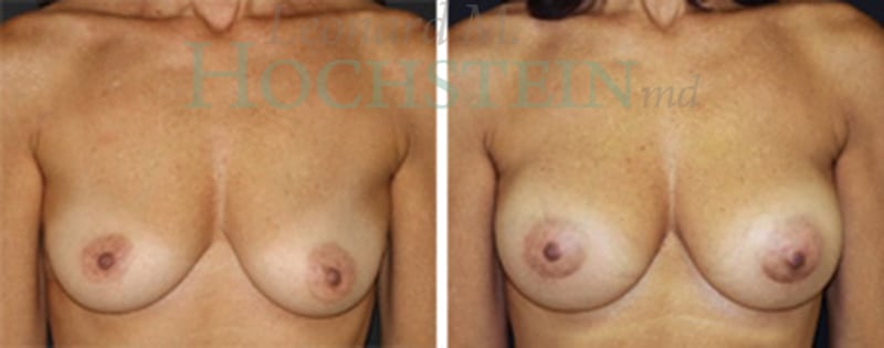Breast Augmentation Patient