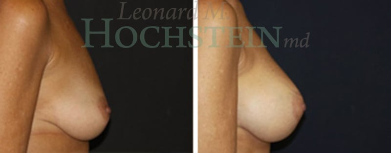 Breast Augmentation Patient