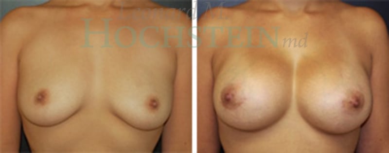 Breast Augmentation Patient