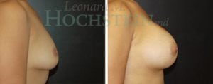 Breast Augmentation Patient