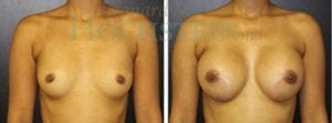 Breast Augmentation Patient