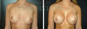 Breast Augmentation Patient
