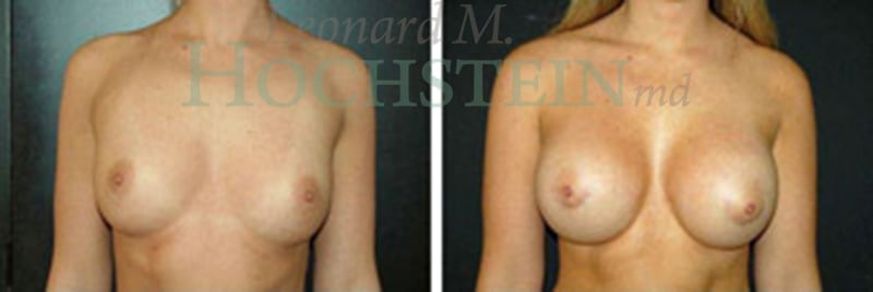 Breast Augmentation Patient