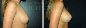 Breast Augmentation Patient