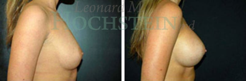 Breast Augmentation Patient