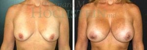 Breast Augmentation Patient
