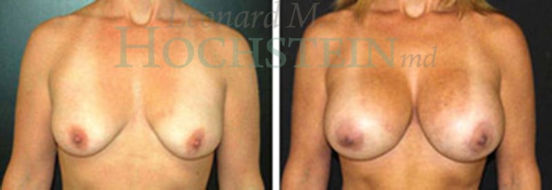 Breast Augmentation Patient