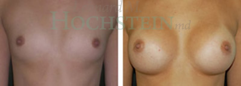Breast Augmentation Patient