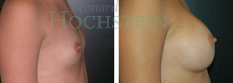 Breast Augmentation Patient