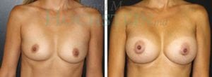 Breast Augmentation Patient