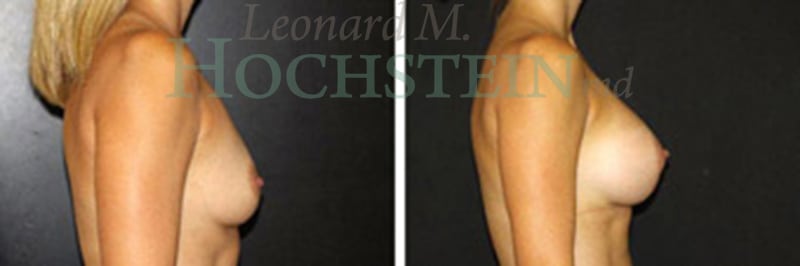 Breast Augmentation Patient