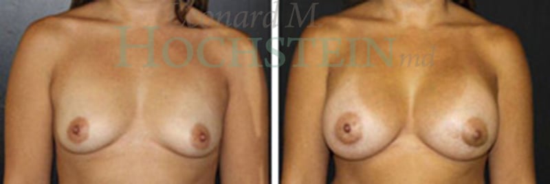 Breast Augmentation Patient