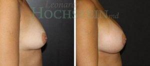 Breast Augmentation Patient