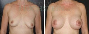 Breast Augmentation Patient