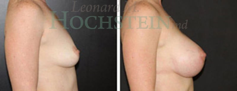 Breast Augmentation Patient