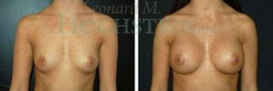 Breast Augmentation Patient