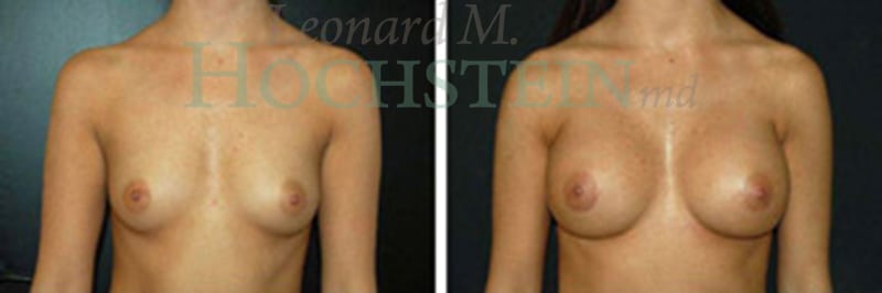 Breast Augmentation Patient