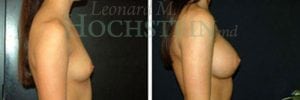 Breast Augmentation Patient